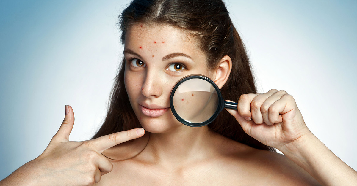 How To Get Rid Of Pimples Naturally and Fast?